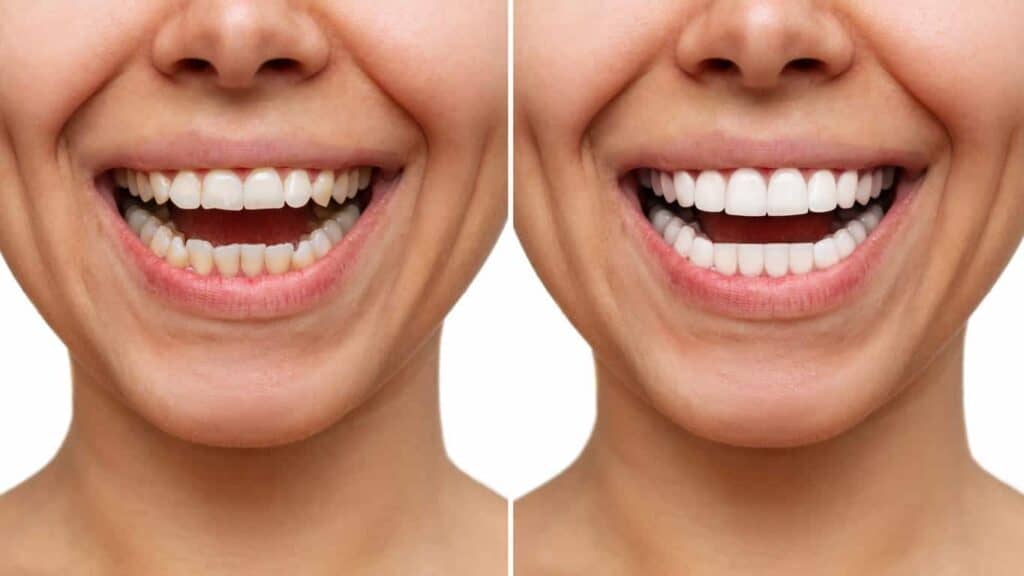 Contact Aspire White for teeth whitening services – Get in touch with Lincoln today