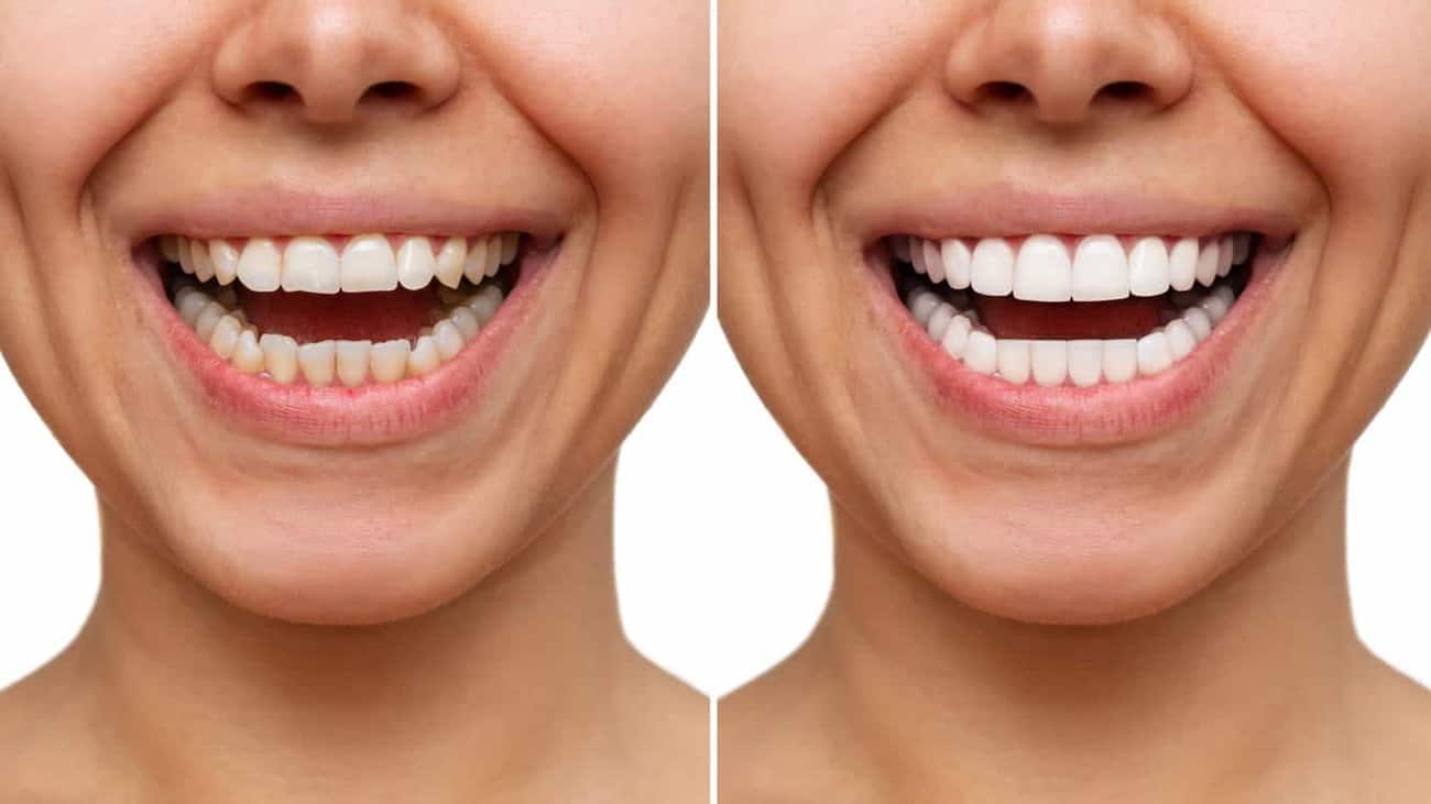 Contact Aspire White for teeth whitening services – Get in touch with Lincoln today