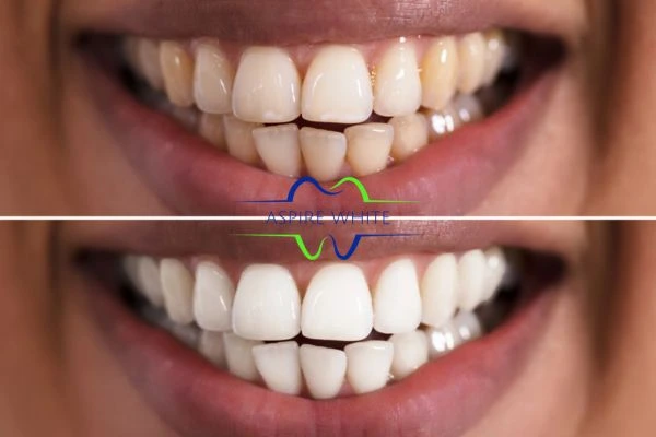 Aspire White customer before and after Lincoln results.