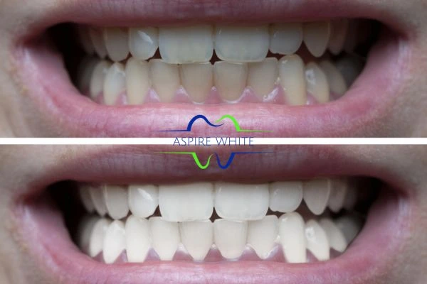 1 hour laser teeth whitening before and after results Lincoln