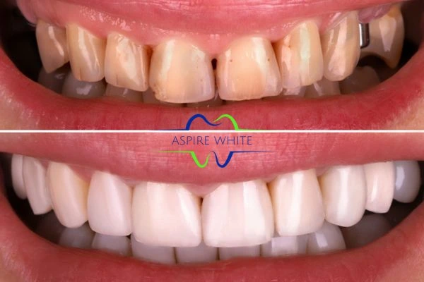Before And After Results Lincoln