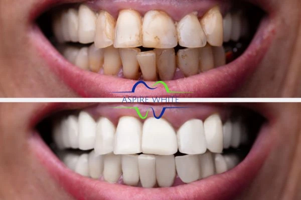 Before and after results of laser teeth whitening Lincoln Book in online today!