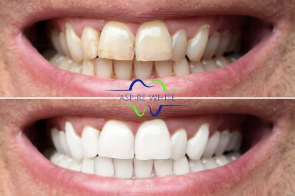 Achieve a radiant smile with professional laser teeth whitening Lincoln